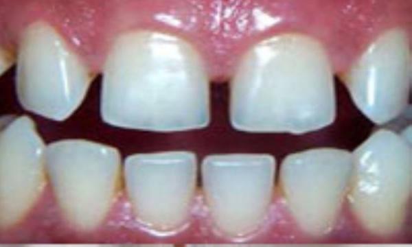 درمان فاصله های بین دندانی